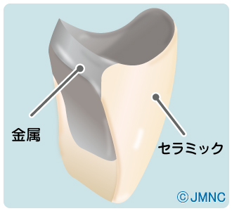 メタルボンド