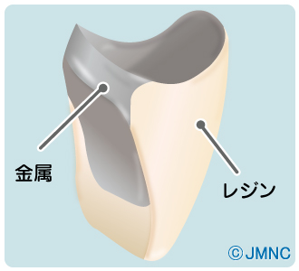 保険の前装冠