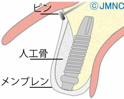 インプラント